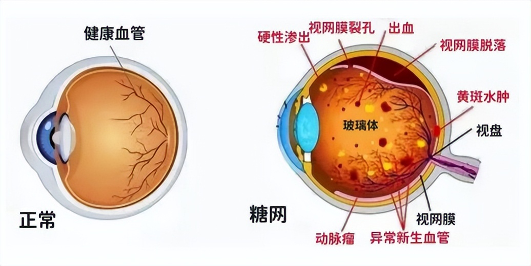 糖尿病逆转治疗3个月，视力大幅度提升，免费筛查开始啦