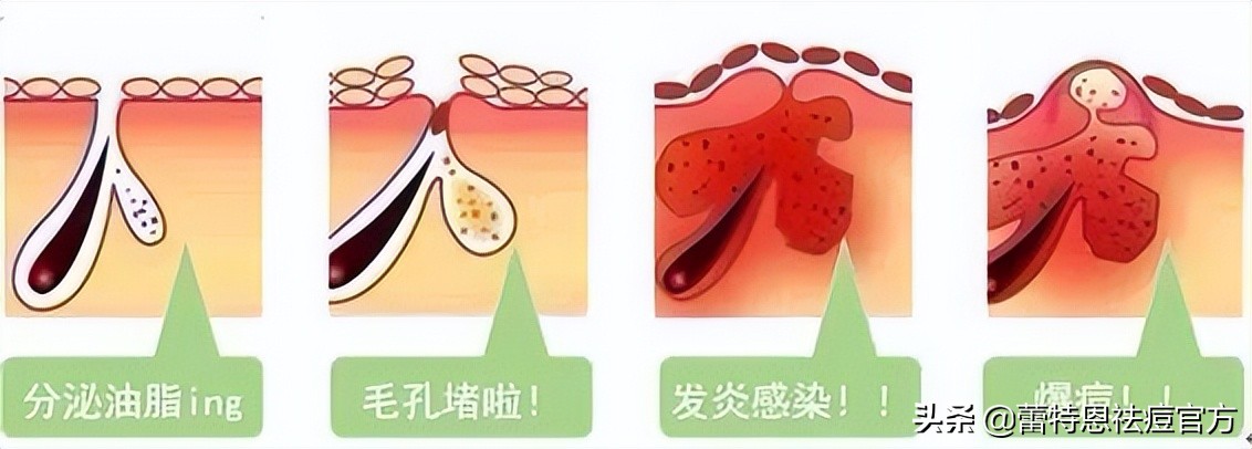 蕾特恩祛痘痘过程,蕾特恩长痘痘严重吗