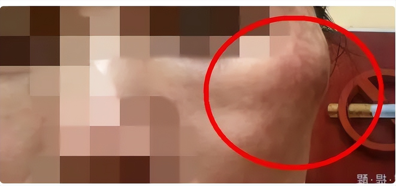 315曝光美容注射,315美容针曝光