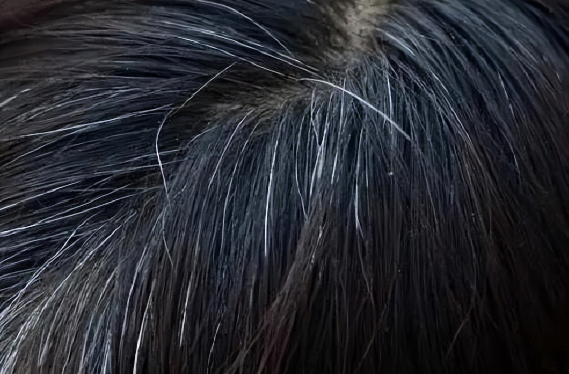 为什么白头发营养不足还一直长,白头发越来越多缺少什么营养