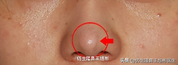 假体隆鼻和自体隆鼻的区别,隆鼻是假体好还是膨体好