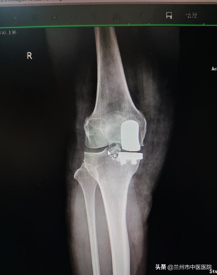 兰州市中医骨伤科医院,兰州中医骨伤科医院康复科