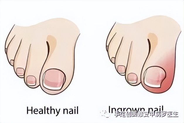 不要等孩子出了问题才重视,孩子得了甲沟炎怎么自己治疗