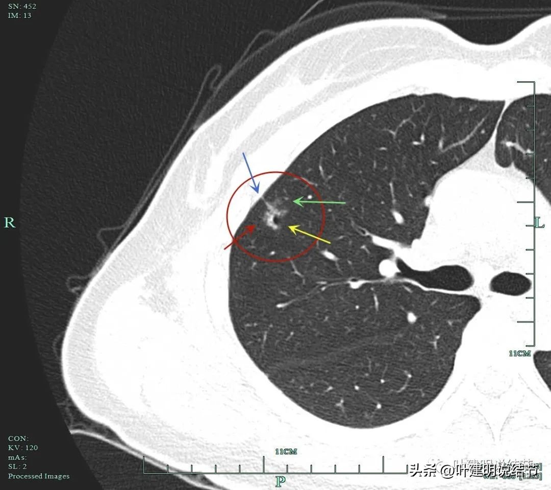 磨玻璃结节伴有增生是癌症吗,磨玻璃结节会是别的癌转移的吗
