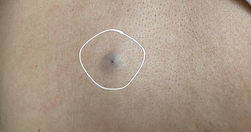 脖子和腋下的“小肉粒”是什么？能直接用手揪掉吗？医生揭露真相