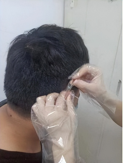 名医面对面丨夏立君：经常熬夜、酗酒，当心“玫瑰*疮痤**”！