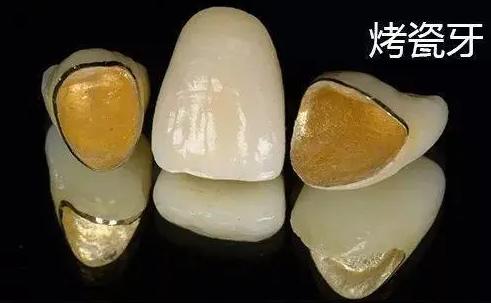 全瓷牙和烤瓷牙相比哪个更结实,全瓷牙和烤瓷牙哪个质量好一点