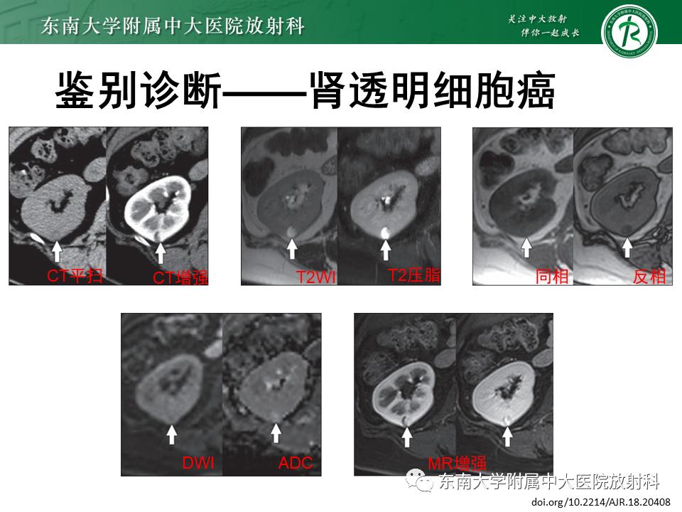好文分享——《肾血管平滑肌脂肪瘤》
