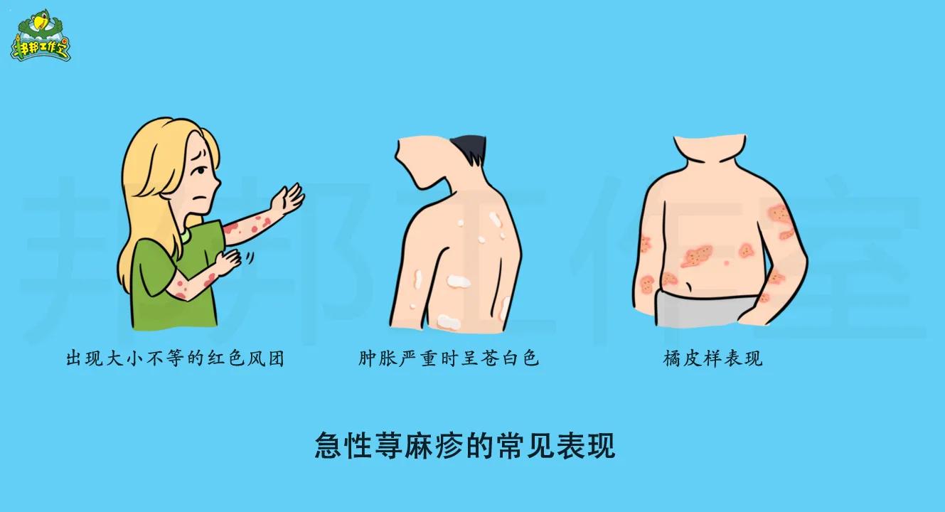 治疗急性荨麻疹的药哪些好,治疗急性荨麻疹有什么特效药吗