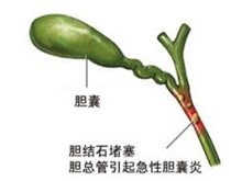 胆囊炎早晨最佳食谱,胆囊炎每日正确食谱