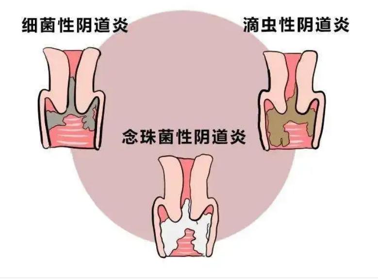 详细白带常规怎么看报告,白带常规检查清洁度3