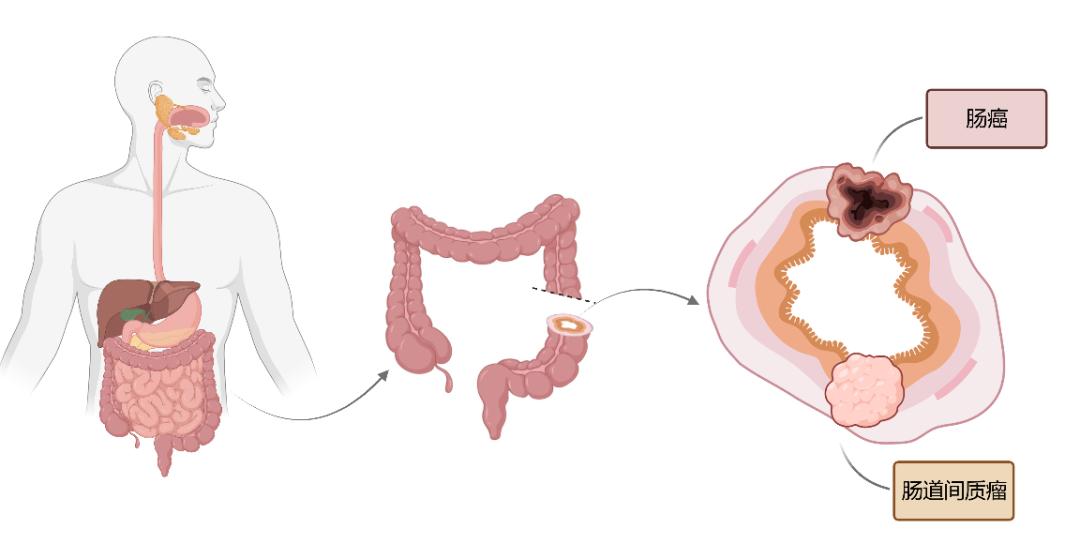 胃肠间质瘤属于肠癌吗,胃肠间质瘤会遗传吗