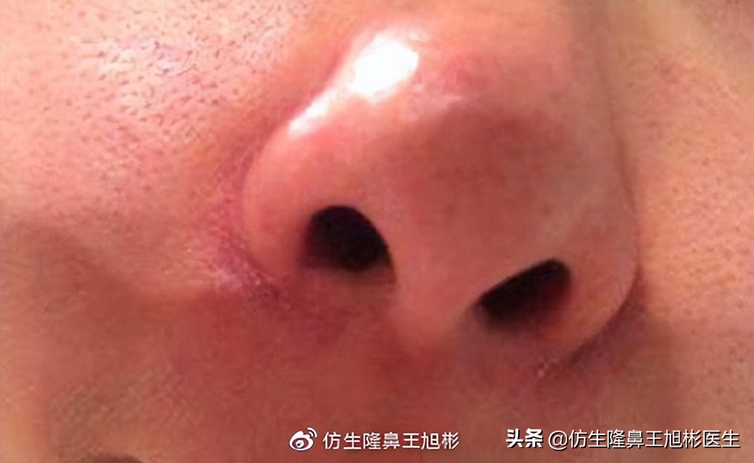 假体隆鼻的危害和后遗症,隆鼻整形麻醉你能坚持多长时间