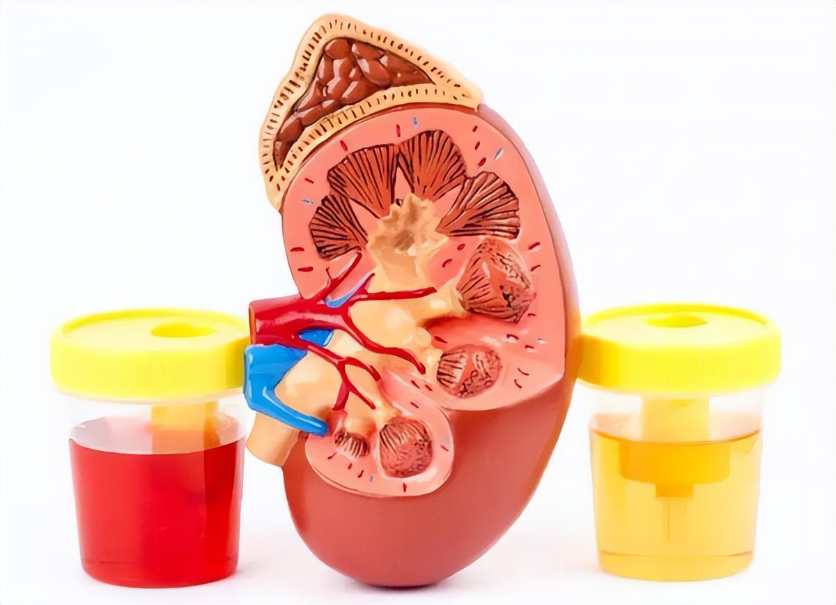 iga肾病能用中药治愈吗,女性得了iga肾病能活多久