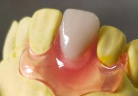 牙齿隐裂牙根完好可以保住么,牙齿蛀虫后只剩牙根要不要拔掉