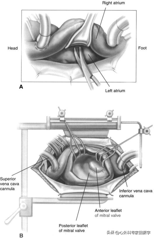 二尖瓣成形术要多少钱,二尖瓣成形术后抗凝多久