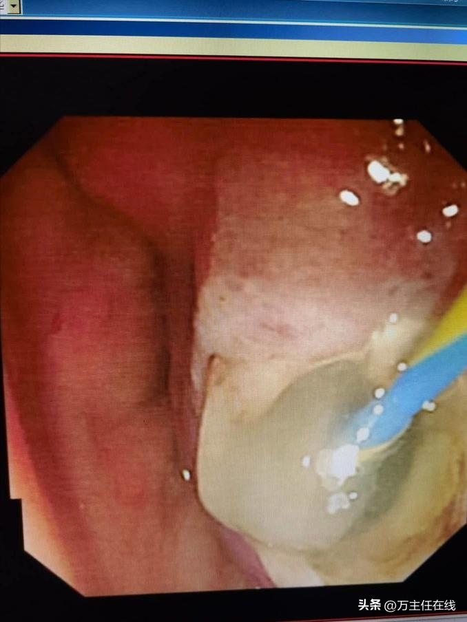 腹腔粘液癌治疗有妙招——万荣教授以内镜Notes技术成功胃减压