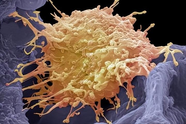 女子长期腿痛查出宫颈癌,女子患宫颈癌