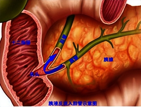 胆囊切除后腹胀怎么回事,胆囊切除术后腹胀怎么办