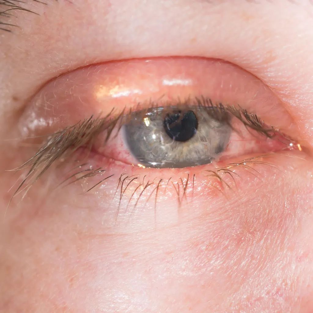 结膜炎畏光流泪还有点模糊怎么办,眼睛怕光迎风流泪结膜炎