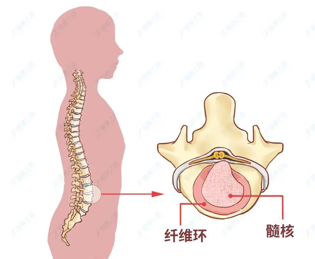 腰椎间盘突出复发贴什么膏药有效,腰椎间盘突出微创后还容易复发吗
