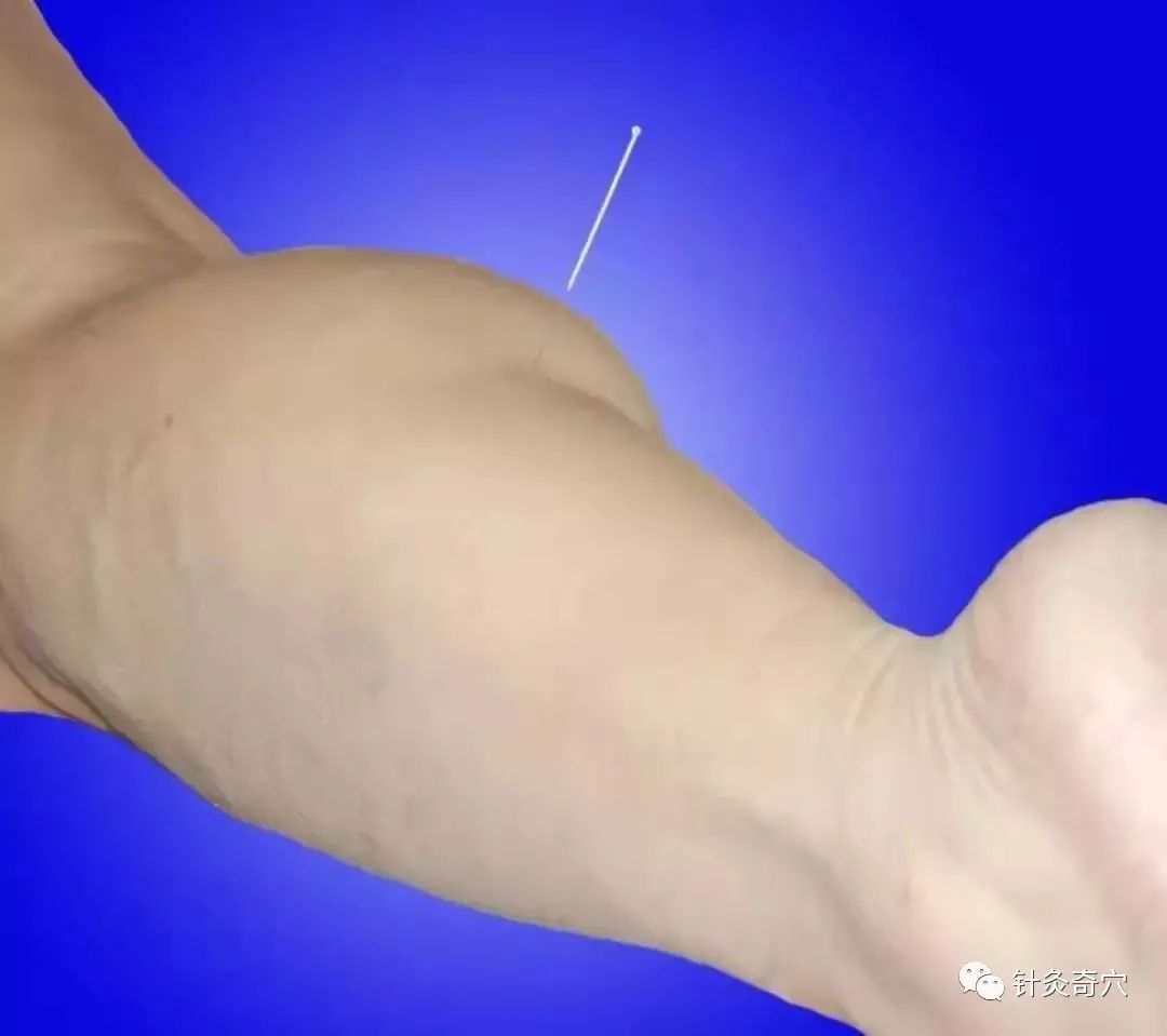 史上最全中医针灸视频教程全集,针灸治疗真实图片大全