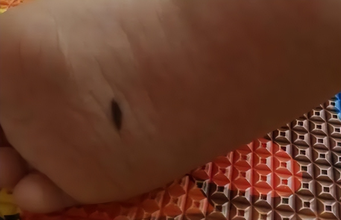 医生发现大黑痣的秘密,这些地方长黑痣要注意