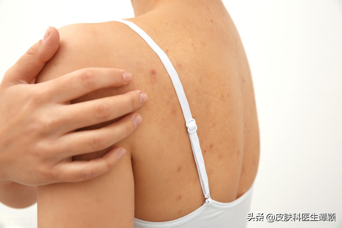 皮肤科疥疮的正确治疗,皮肤科医生怎么样确诊疥疮