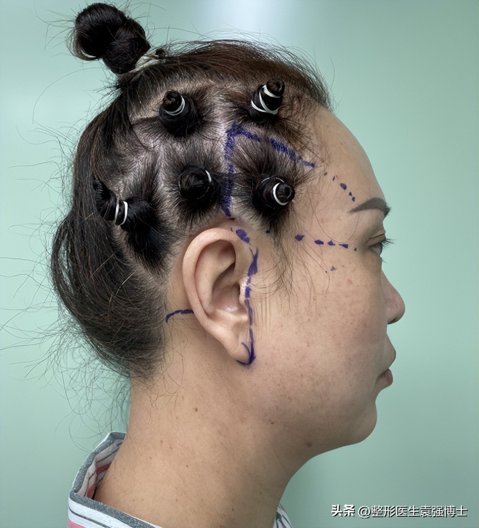 拉皮手术后的疤痕图片,耳前切口拉皮疤痕图片