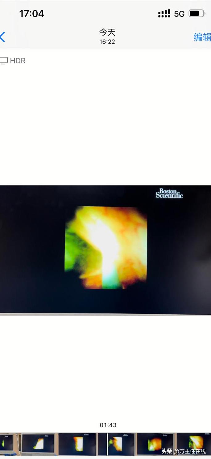 胆结石化脓性胆囊炎,妙手神针巧治疑难杂症