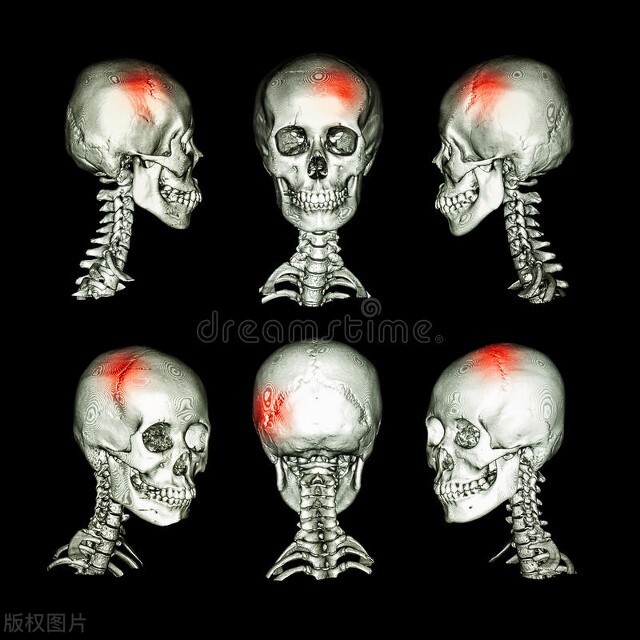 常见老年人头痛原因分析,老年人每天中午头痛头晕怎么回事