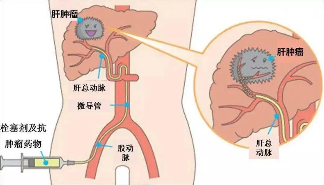 手术治疗癌症会好吗,手术介入化疗效果