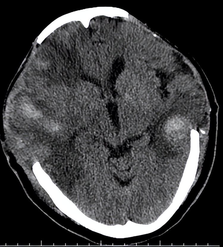 医院成功救治重型颅脑患者,特重型颅脑损伤治愈案