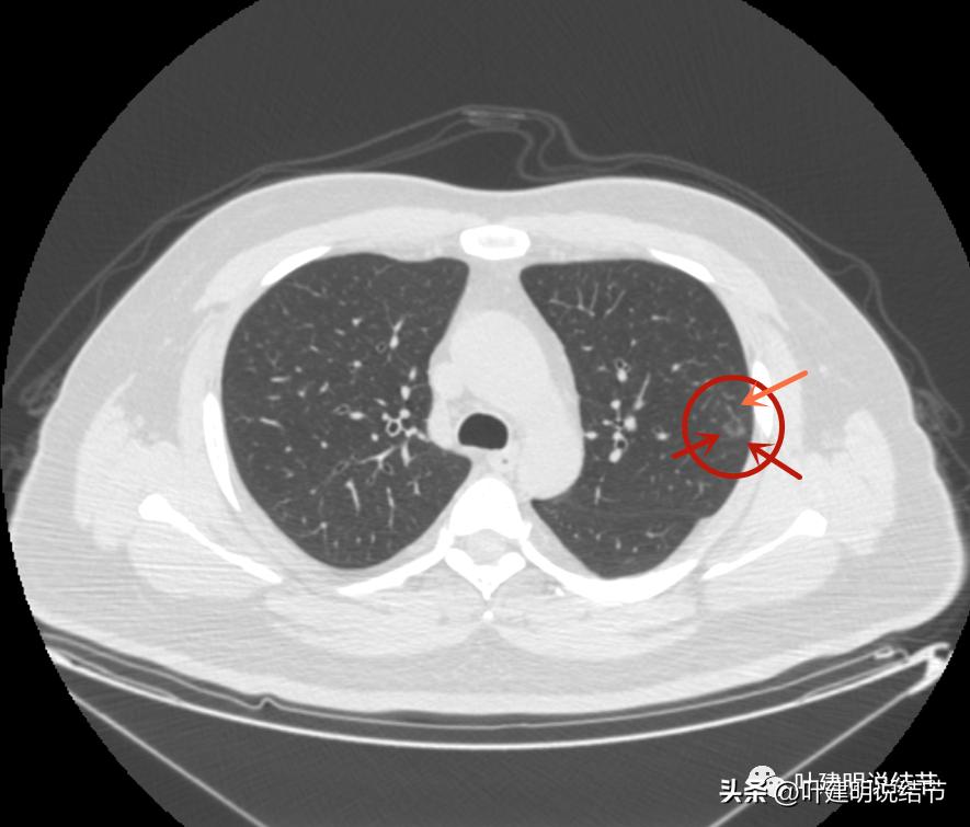如何判断肺磨玻璃结节是高危结节,肺上有混合磨玻璃结节要注意什么