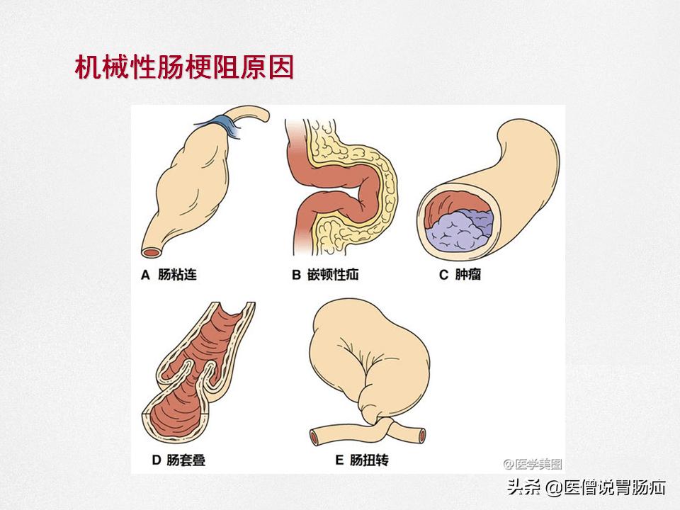 肠梗阻健康教育,肠梗阻患者的健康宣教