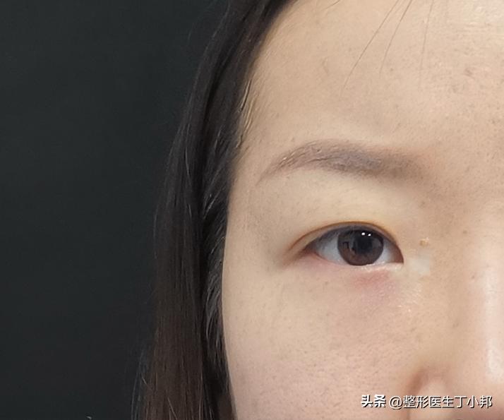 眼尾下垂眼综合可以调整吗,大小眼眼皮松弛怎么改善
