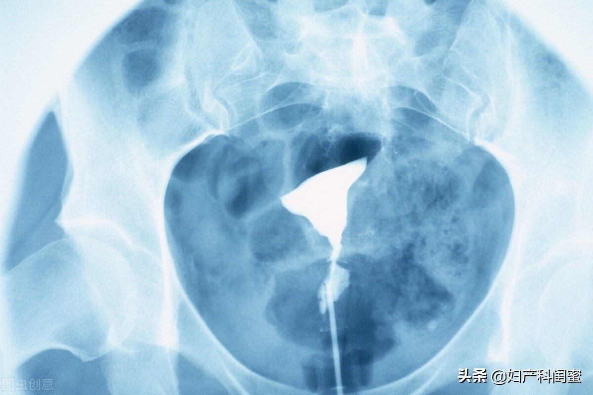 此路通不通，您痛不痛！子宫输卵管造影，最关心、担心的都在这