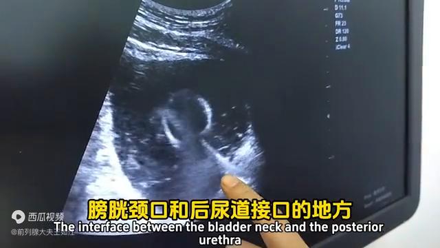 孔院长解读：什么是尿道疏通扩张术？配合前列腺钙化消融术...