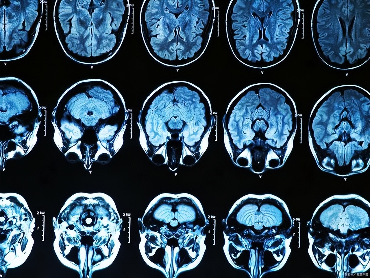 国产核磁共振什么时候打破垄断,国产核磁共振正式打破垄断