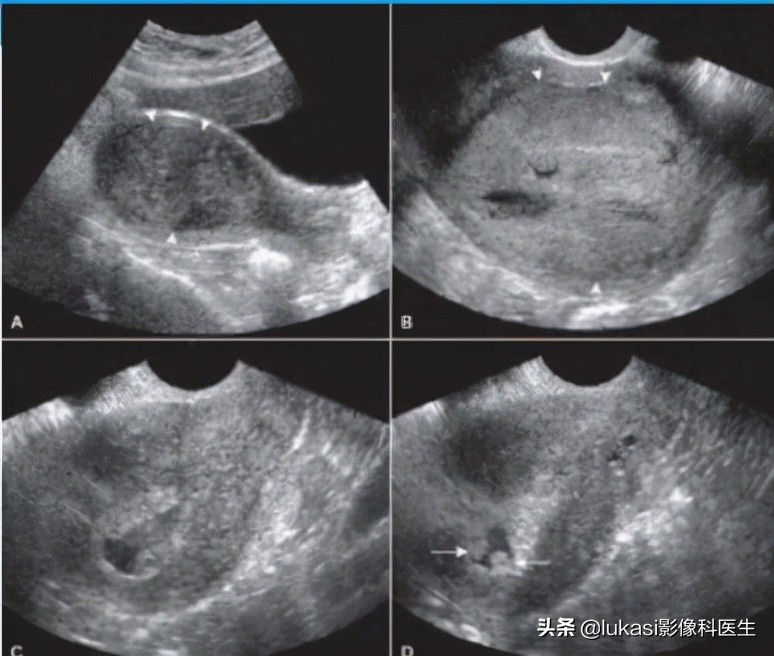 绝经后子宫内膜癌征兆,绝经后子宫癌症早期信号