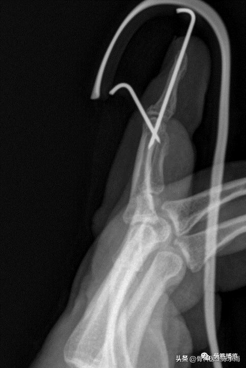 手指出现锤状畸形不要太紧张，看后知道伸肌腱止点断裂重建术