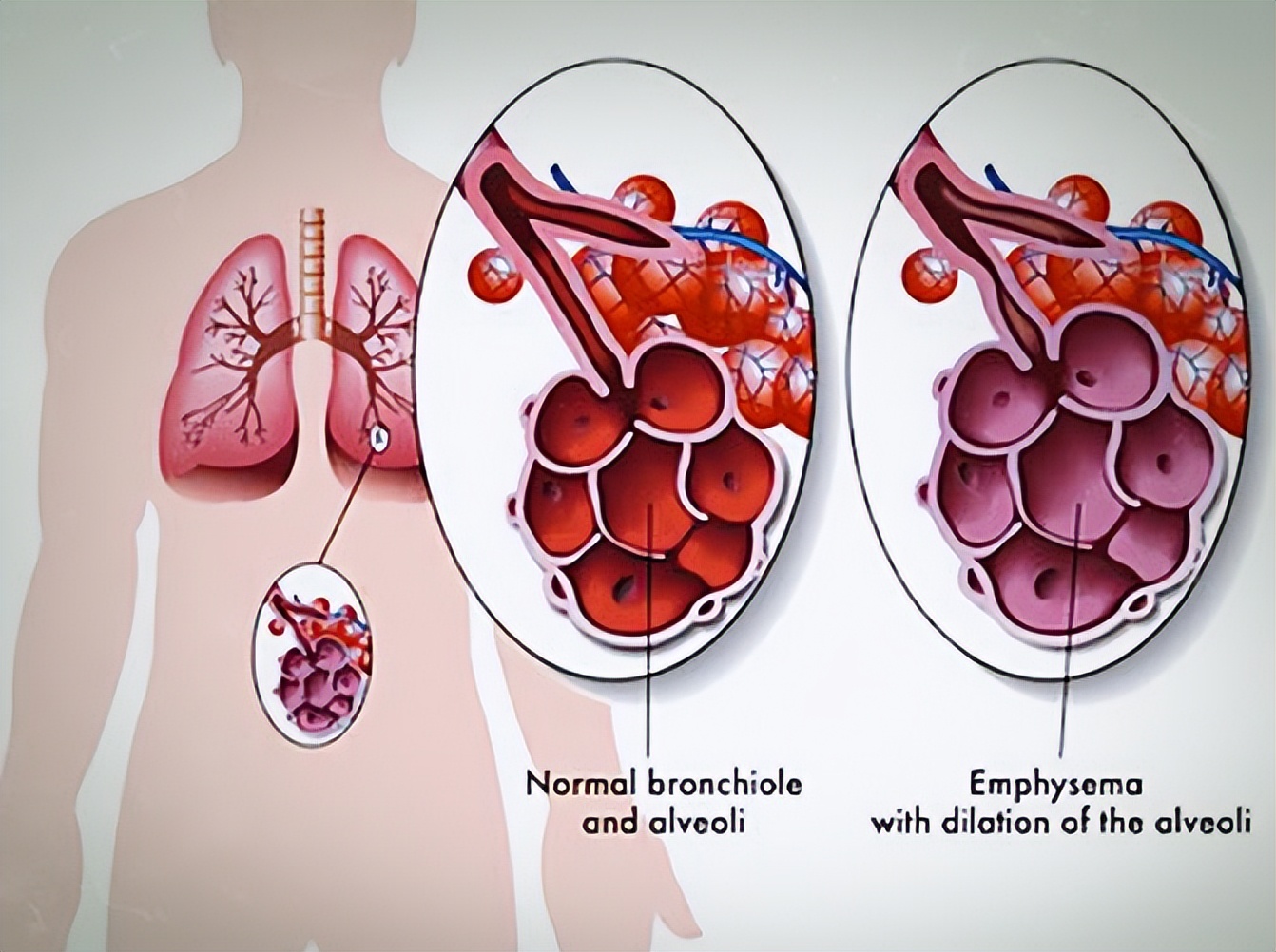 肺气肿病因,肺炎肺气肿