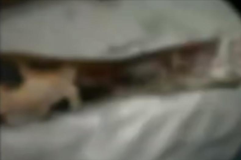 20岁小伙被重度烧伤七年后续,山东男子下肢被烧伤