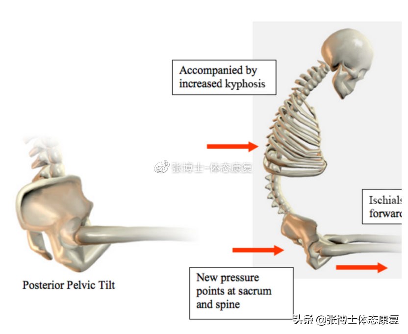 「体态康复」缓解下背痛的十六条建议