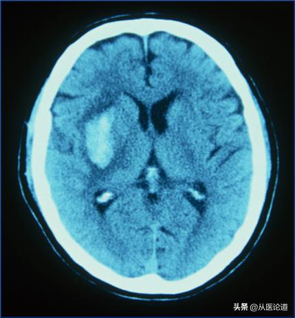 免疫性血小板减少性紫癜itp,血小板减少性紫癜紫斑消失慢