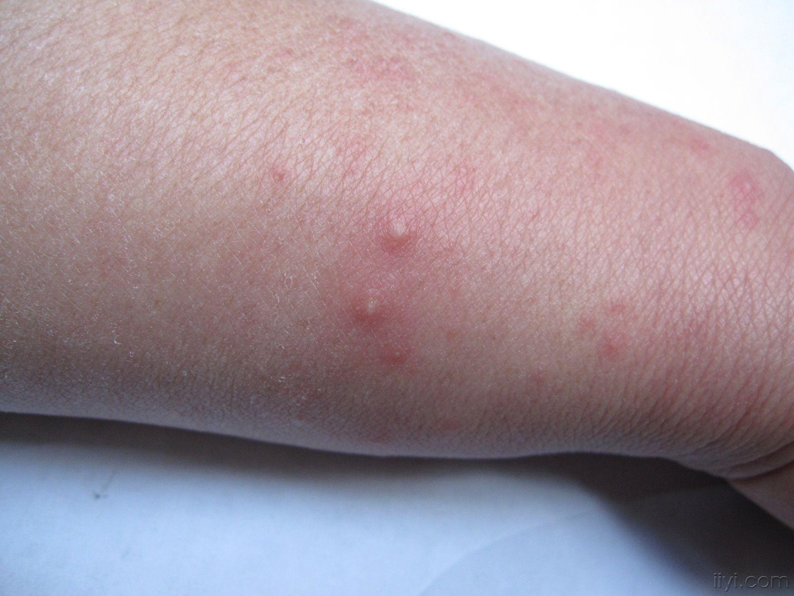 在“深入了解”前，如何判断对象有没有性病？医生：这几点要记住