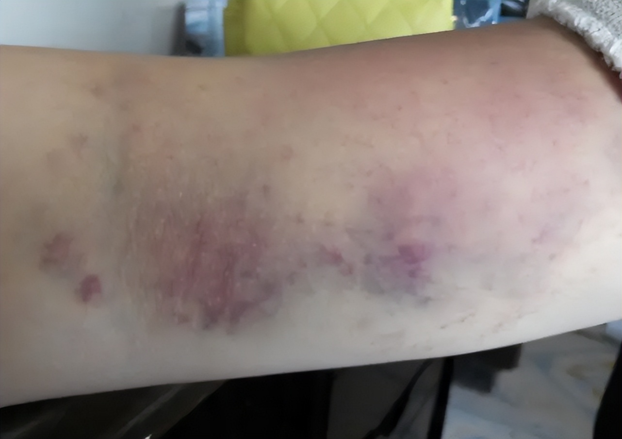 筋膜枪对人体有害吗,筋膜枪的弊端