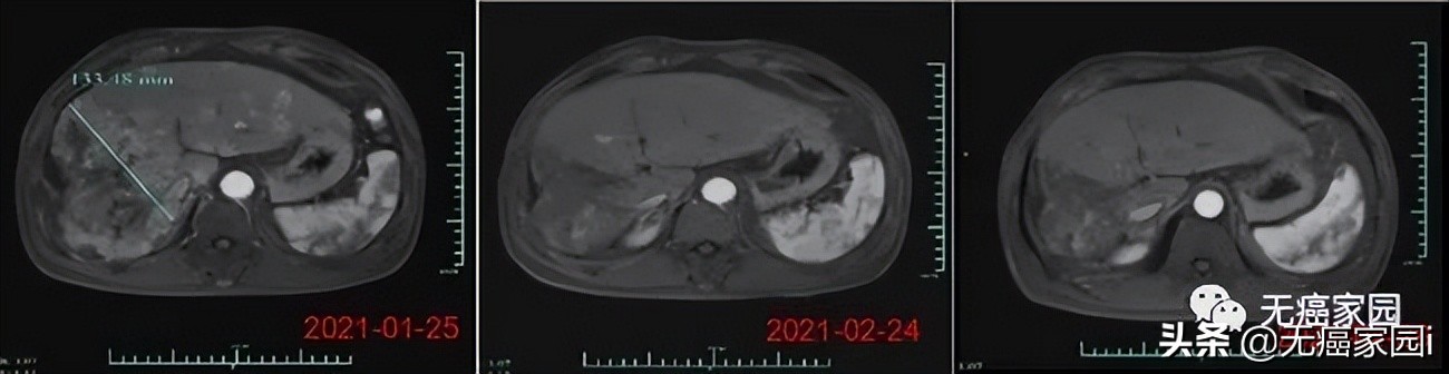 肝癌的防治干预计划,肝癌患者免疫治疗需长期治疗吗