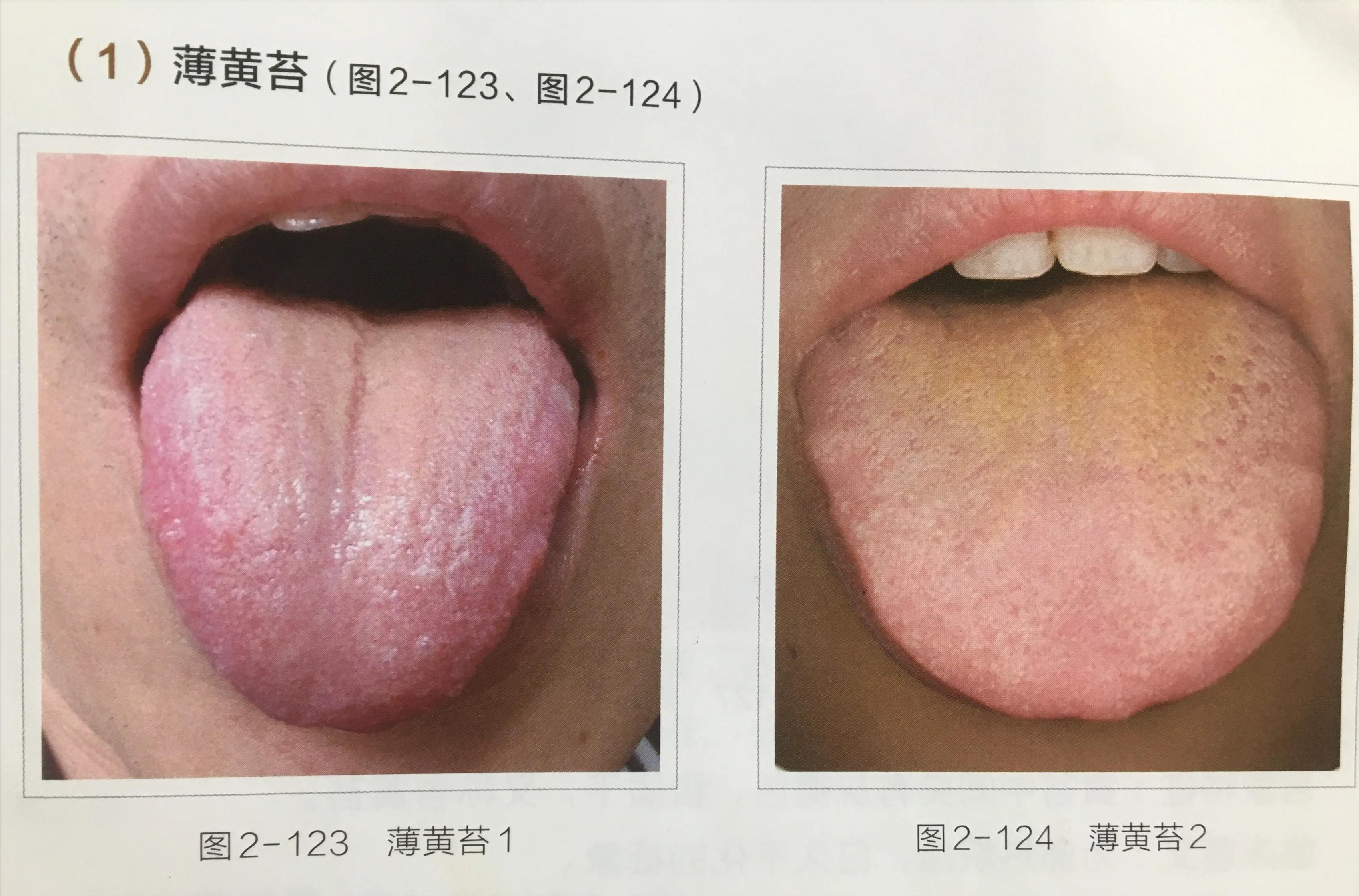 苔白舌诊与疾病对照图,舌诊中舌质红且有苔