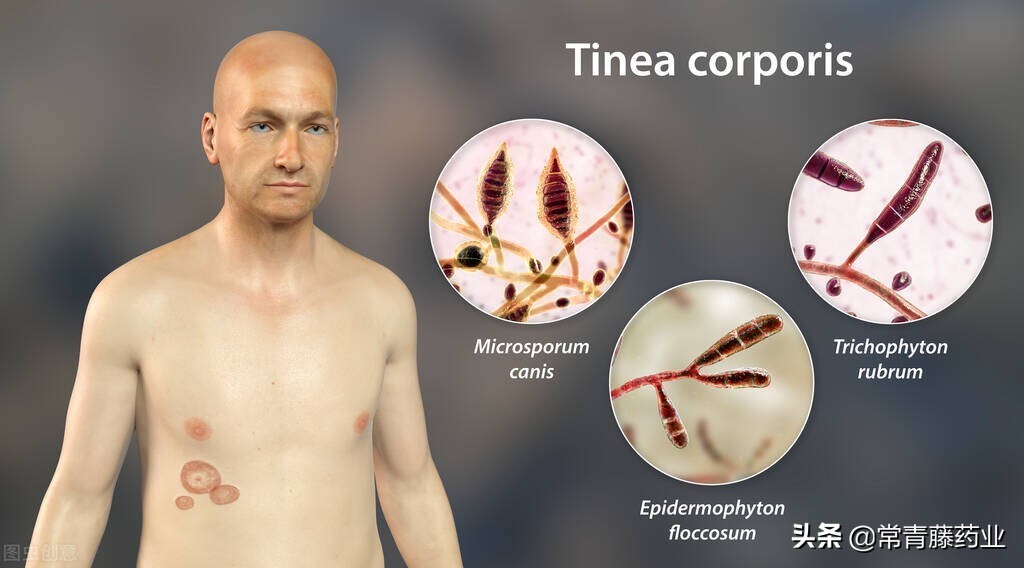 下体生癣要擦什么药膏好,霉菌一定要彻底清除吗